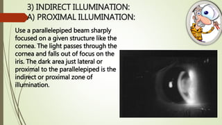 3) INDIRECT ILLUMINATION:
A) PROXIMAL ILLUMINATION:
Use a parallelepiped beam sharply
focused on a given structure like the
cornea. The light passes through the
cornea and falls out of focus on the
iris. The dark area just lateral or
proximal to the parallelepiped is the
indirect or proximal zone of
illumination.
 