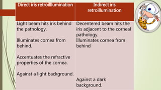 Direct iris retroilllumination Indirect iris
retroillumination
Light beam hits iris behind
the pathology.
Illuminates cornea from
behind.
Accentuates the refractive
properties of the cornea.
Against a light background.
Decentered beam hits the
iris adjacent to the corneal
pathology.
Illuminates cornea from
behind
Against a dark
background.
 
