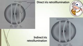 Direct iris retroilllumination
Indirect iris
retroillumination
 