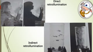 Direct
retroillumination
Indirect
retroillumination
 