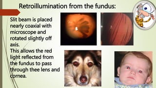 Retroillumination from the fundus:
Slit beam is placed
nearly coaxial with
microscope and
rotated slightly off
axis.
This allows the red
light reflected from
the fundus to pass
through thee lens and
cornea.
 