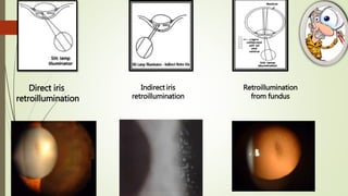 Direct iris
retroillumination
Indirect iris
retroillumination
Retroillumination
from fundus
 