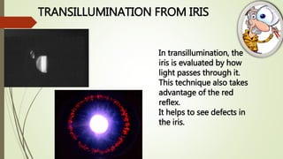 TRANSILLUMINATION FROM IRIS
In transillumination, the
iris is evaluated by how
light passes through it.
This technique also takes
advantage of the red
reflex.
It helps to see defects in
the iris.
 
