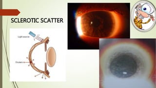 SCLEROTIC SCATTER
 