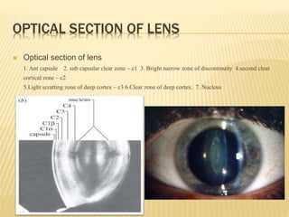 Normal Lens Slit Map Slit lamp – biomicroscopy of eye | PPTX
