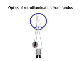 Optics of retroillumination from fundus
 