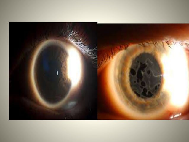Slit lamp examination lecture | PPTX