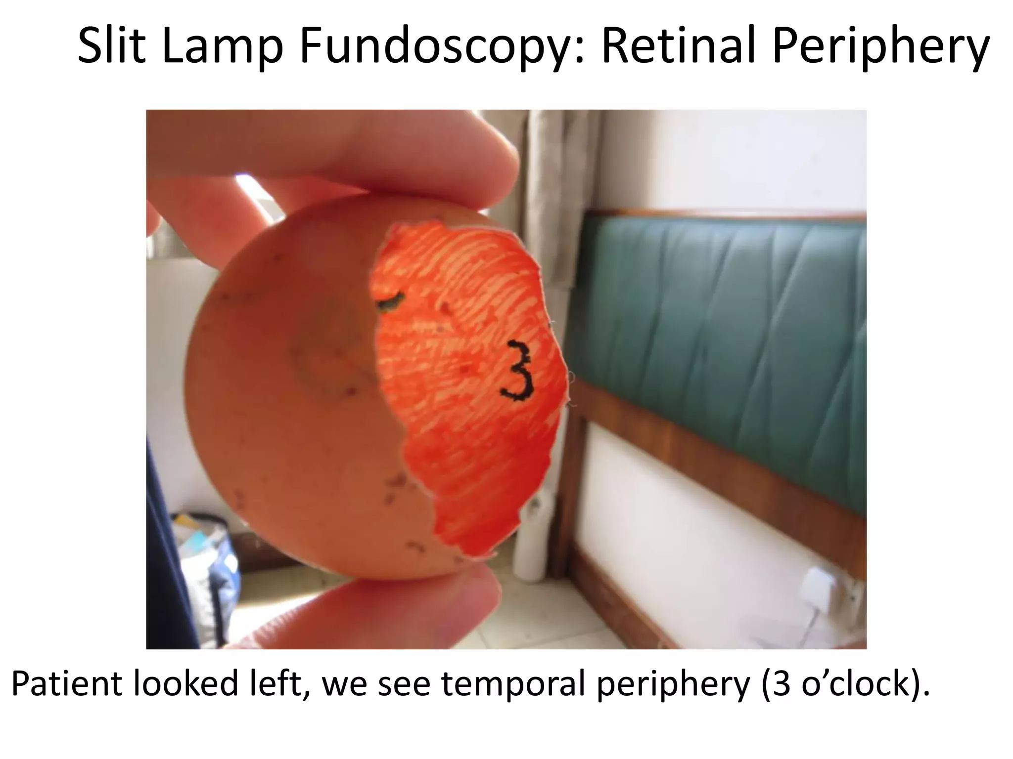 Slit lamp fundoscopy | PPTX
