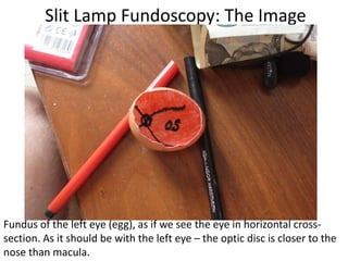 Slit Lamp Fundoscopy: The Image
Fundus of the left eye (egg), as if we see the eye in horizontal cross-
section. As it should be with the left eye – the optic disc is closer to the
nose than macula.
 