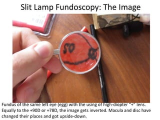 Slit Lamp Fundoscopy: The Image
Fundus of the same left eye (egg) with the using of high-diopter “+” lens.
Equally to the +90D or +78D, the image gets inverted. Macula and disc have
changed their places and got upside-down.
 
