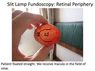 Slit Lamp Fundoscopy: Retinal Periphery
Patient fixated straight. We receive macula in the field of
view.
 