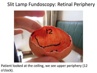 Slit Lamp Fundoscopy: Retinal Periphery
Patient looked at the ceiling, we see upper periphery (12
o’clock).
 