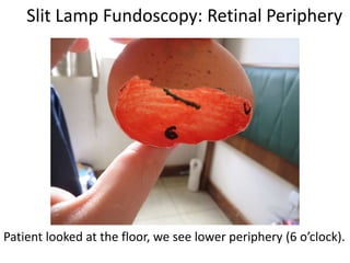 Slit Lamp Fundoscopy: Retinal Periphery
Patient looked at the floor, we see lower periphery (6 o’clock).
 
