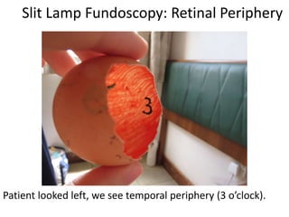 Slit Lamp Fundoscopy: Retinal Periphery
Patient looked left, we see temporal periphery (3 o’clock).
 