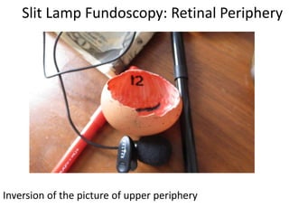 Slit Lamp Fundoscopy: Retinal Periphery
Inversion of the picture of upper periphery
 