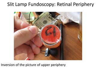 Slit Lamp Fundoscopy: Retinal Periphery
Inversion of the picture of upper periphery
 