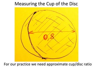 Measuring the Cup of the Disc
For our practice we need approximate cup/disc ratio
 