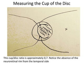 Measuring the Cup of the Disc
This cup/disc ratio is approximately 0,7. Notice the absence of the
neuroretinal rim from the temporal side
 