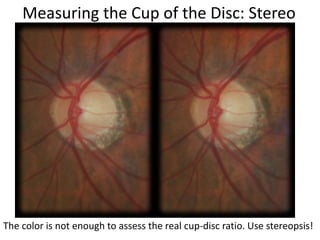 Measuring the Cup of the Disc: Stereo
The color is not enough to assess the real cup-disc ratio. Use stereopsis!
 