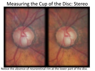 Notice the absence of neuroretinal rim at the lower part of the disc
Measuring the Cup of the Disc: Stereo
 