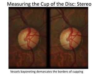 Measuring the Cup of the Disc: Stereo
Vessels bayoneting demarcates the borders of cupping
 