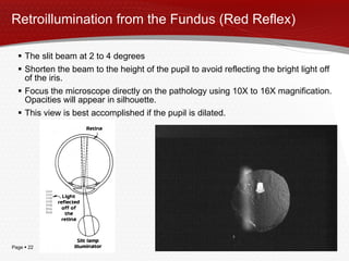 Retroillumination from the Fundus (Red Reflex) The slit beam at 2 to 4 degrees Shorten the beam to the height of the pupil to avoid reflecting the bright light off of the iris. Focus the microscope directly on the pathology using 10X to 16X magnification. Opacities will appear in silhouette. This view is best accomplished if the pupil is dilated. 