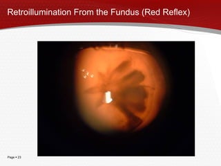 Retroillumination From the Fundus (Red Reflex) 