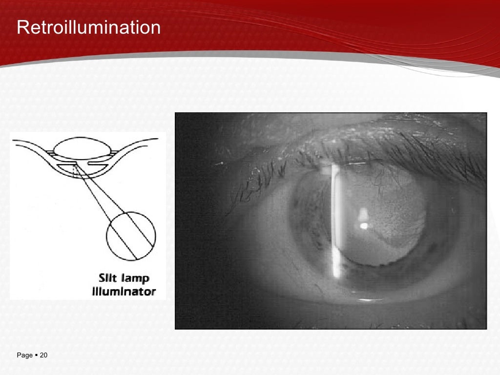Slit Lamp Illumination Techniques