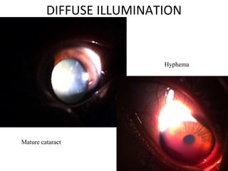 DIFFUSE ILLUMINATION
Mature cataract
Hyphema
 
