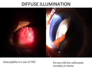 DIFFUSE ILLUMINATION
Giant papillae in a case of VKC Iris tear with lens subluxation
secondary to trauma
 