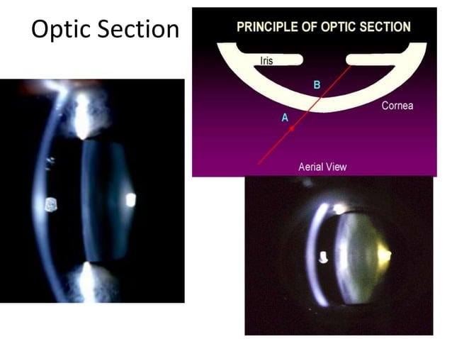Normal Lens Slit Map Slit lamp techniques.pptx