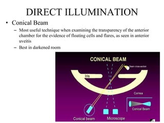 DIRECT ILLUMINATION
• Conical Beam
– Most useful technique when examining the transparency of the anterior
chamber for the evidence of floating cells and flares, as seen in anterior
uveitis
– Best in darkened room
 