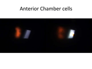 Anterior Chamber cells
 