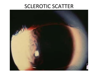 SCLEROTIC SCATTER
 