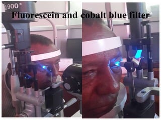 Fluorescein and cobalt blue filter
 