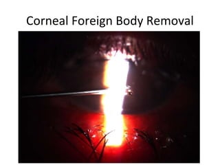 Corneal Foreign Body Removal
 