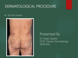 DERMATOLOGICAL PROCEDURE
 Slit skin smears
Presented By
Dr. Faiqa Qadeer
FCPS Trainee Dermatology
SIMS/SHL
 