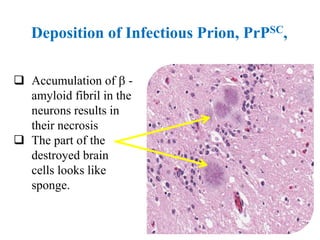 Deposition of Infectious Prion, PrPSC,
 Accumulation of  -
amyloid fibril in the
neurons results in
their necrosis
 The part of the
destroyed brain
cells looks like
sponge.
 