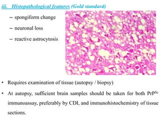 iii. Histopathological features (Gold standard)
– spongiform change
– neuronal loss
– reactive astrocytosis
• Requires examination of tissue (autopsy / biopsy)
• At autopsy, sufficient brain samples should be taken for both PrPSc
immunoassay, preferably by CDI, and immunohistochemistry of tissue
sections.
 