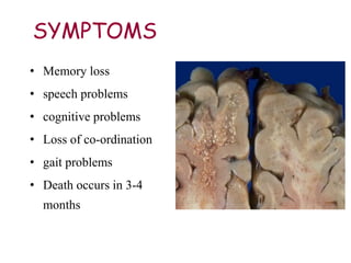 SYMPTOMS
• Memory loss
• speech problems
• cognitive problems
• Loss of co-ordination
• gait problems
• Death occurs in 3-4
months
 
