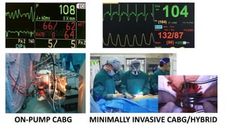 Impact of R-CABG on Postop Strokes
• Hospital costs
• Postacute care
• Return to work
• Malpractice premiums
• Word of mou...