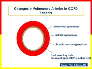 Chronic Obstructive Pulmonary Disease | PPTX