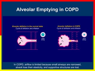 Alveolar Emptying in COPD
In COPD, airflow is limited because small airways are narrowed,
alveoli lose their elasticity, and supportive structures are lost.
 