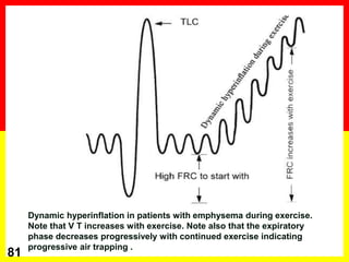 81
Dynamic hyperinflation in patients with emphysema during exercise.
Note that V T increases with exercise. Note also that the expiratory
phase decreases progressively with continued exercise indicating
progressive air trapping .
 