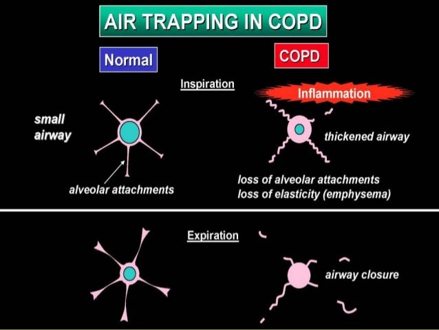 COPD back to basis