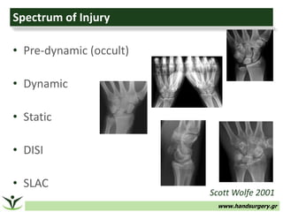 www.handsurgery.gr
Spectrum of Injury
• Pre-dynamic (occult)
• Dynamic
• Static
• DISI
• SLAC
Scott Wolfe 2001
 