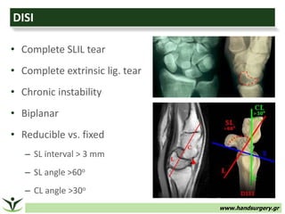 www.handsurgery.gr
DISI
• Complete SLIL tear
• Complete extrinsic lig. tear
• Chronic instability
• Biplanar
• Reducible vs. fixed
– SL interval > 3 mm
– SL angle >60o
– CL angle >30o
 
