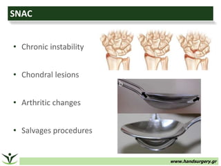 www.handsurgery.gr
SNAC
• Chronic instability
• Chondral lesions
• Arthritic changes
• Salvages procedures
 