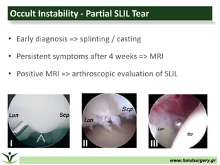 www.handsurgery.gr
Occult Instability - Partial SLIL Tear
• Early diagnosis => splinting / casting
• Persistent symptoms after 4 weeks => MRI
• Positive MRI => arthroscopic evaluation of SLIL
I II III
 