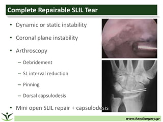 www.handsurgery.gr
• Dynamic or static instability
• Coronal plane instability
• Arthroscopy
– Debridement
– SL interval reduction
– Pinning
– Dorsal capsulodesis
• Mini open SLIL repair + capsulodesis
Complete Repairable SLIL Tear
 